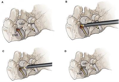 Transforaminal endoscopic lumbar foraminotomy for octogenarian patients